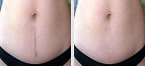 聊城激光祛痘醫(yī)院哪家好？選擇聊城最適合你的激光祛痘醫(yī)院