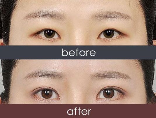 福州哪家醫(yī)院激光祛雀斑效果好？