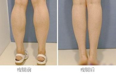 全國激光點痣哪家醫(yī)院好？帶你全面了解最佳選擇！