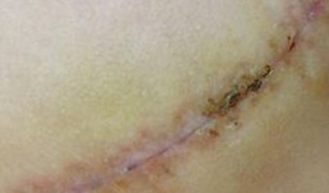 太原疤痕醫(yī)院排名哪家好？解密太原疤痕治療領(lǐng)域中的第一名