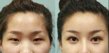 深圳隆鼻手術(shù)效果如何？哪家醫(yī)院的鼻綜合技術(shù)較好？