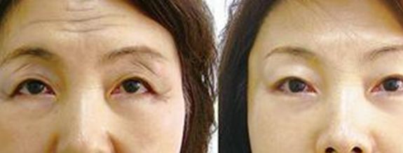 2023廣州玻尿酸填充上眼瞼專家前十口碑排行(沈紹勇、李宗磊、張鑄成醫(yī)美大佬)