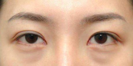 昆明做雙眼皮手術(shù)好的醫(yī)院有哪些？