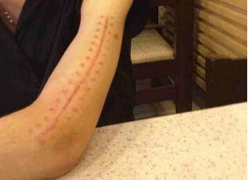 哈爾濱疤痕醫(yī)院哪家好？2023最新排名及患者口碑綜合分析