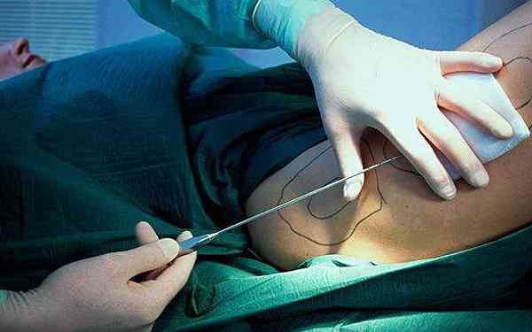 北京東方和諧整形專(zhuān)家馮斌：帶你了解吸脂整形的效果如何