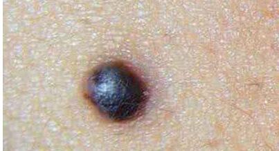 上海沈鶯鶯最新雙眼皮效果揭秘，價(jià)格公開！驚艷案例分享