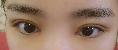 福州哪里可以去除胎記？福州去胎記醫(yī)院排名哪家好？