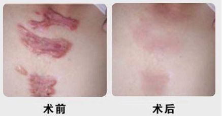 昆明有沒(méi)有哪家專業(yè)祛痘醫(yī)院值得推薦？