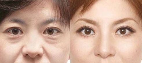 成都做乳暈漂紅哪家好？乳暈漂紅的價(jià)格、效果、方法哪種最合適？