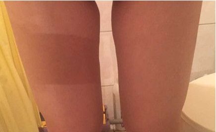 山東哪家醫(yī)院治療疤痕好？挑選最適合您的醫(yī)療機構！