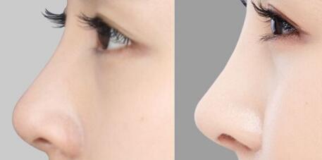 上海羅瀾濤專家評(píng)價(jià)及雙眼皮案例分享