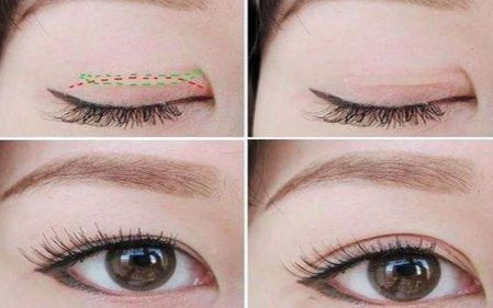 上海打臥蠶哪家醫(yī)院好？選擇上海治療臥蠶一流的醫(yī)院