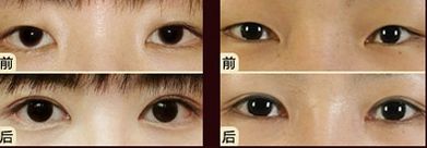 嘟嘟唇無錫哪家醫(yī)院好？專家推薦無錫哪家醫(yī)院治療嘟嘟唇好