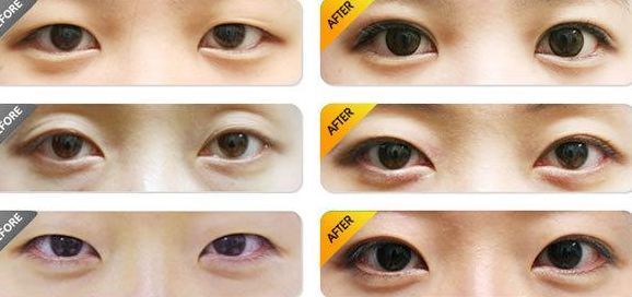 北京做雙眼皮哪家醫(yī)院好？排名最靠前的北京雙眼皮醫(yī)院有哪些？