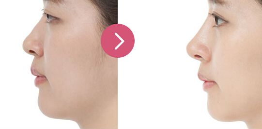 揚(yáng)州私密整形哪家好？專業(yè)推薦！