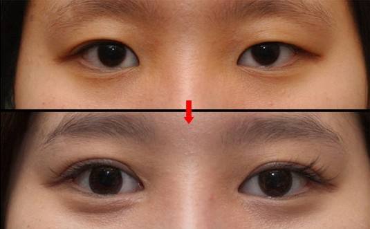 2023昆明微雕去眼周紋口碑10強(qiáng)專家(李元駿、馬志丹、劉小星口碑實(shí)力認(rèn)證)