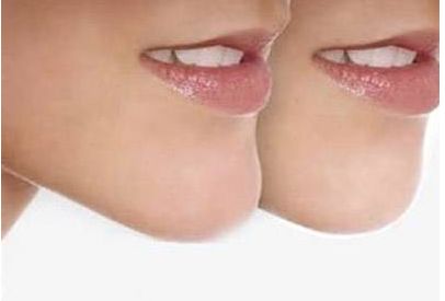 嘉興割雙皮哪家醫(yī)院好？為您推薦嘉興市內(nèi)專業(yè)割雙皮醫(yī)院排行榜