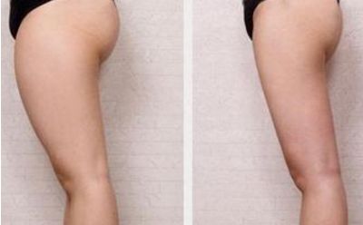 商丘做雙眼皮去哪家好？選擇最適合自己的雙眼皮整形醫(yī)院