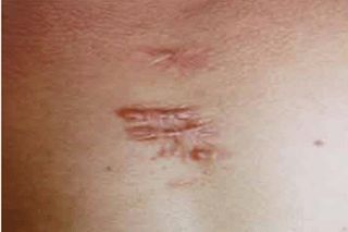 成都祛疤痕效果好的醫(yī)院有哪些？