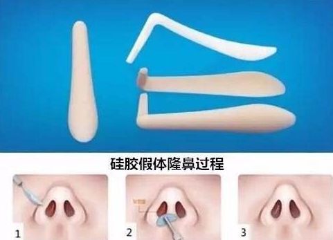 上海哪家醫(yī)院祛斑去痣好？專家?guī)懔私庾钸m合你的祛斑去痣方法！