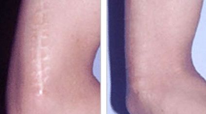 哈爾濱哪家醫(yī)院去除痘痘增生效果好，推薦給大家！