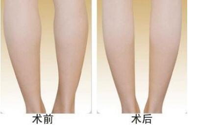 李闖隆鼻效果對(duì)比：神奇改變顏值，素顏?zhàn)孕胖責(zé)ㄇ啻海?></a></div>
                        <div>
                            <h4><a href=