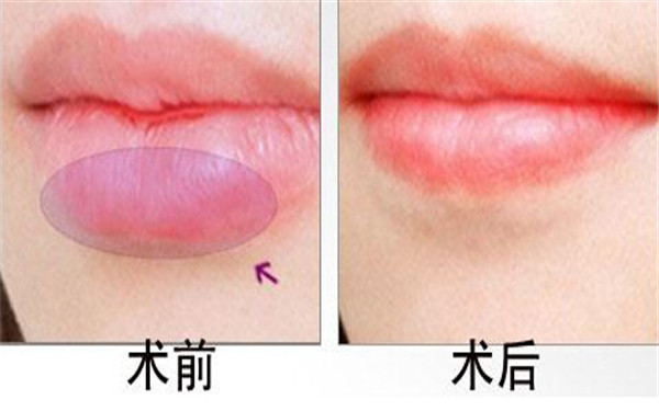 2023廈門線雕改善臉部下垂醫(yī)生排名(邊大偉、楊苓山、肖紅殺出重圍)