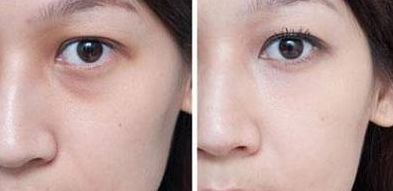 北京楊鍇做雙眼皮手術有哪些收費情況？手術案例一覽