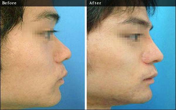 安徽省立醫(yī)院雙眼皮整形專家排行榜丨手術費用詳解丨經典案例分享