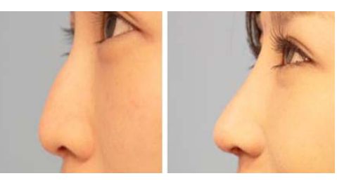 大連瑞和醫(yī)療美容醫(yī)院受歡迎嗎？楊檸澤做雙眼皮效果怎樣？真實網(wǎng)友體驗來了解！