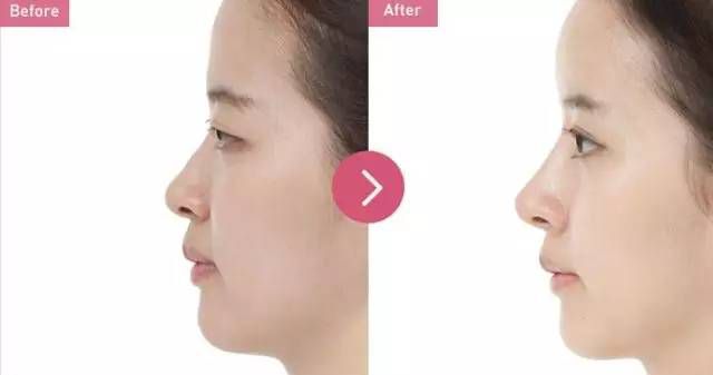 2023寧波面部埋線提升美容口碑前10位醫(yī)生(雷中元、姚遠(yuǎn)、馬文章靠譜技術(shù)好！)