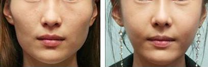 重慶雙眼皮整形醫(yī)院評(píng)價(jià)如何？哪家信譽(yù)好？