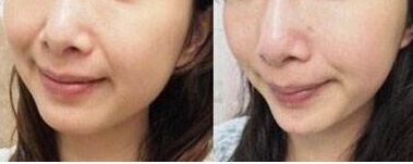 四川哪家醫(yī)院的多指手術效果好？