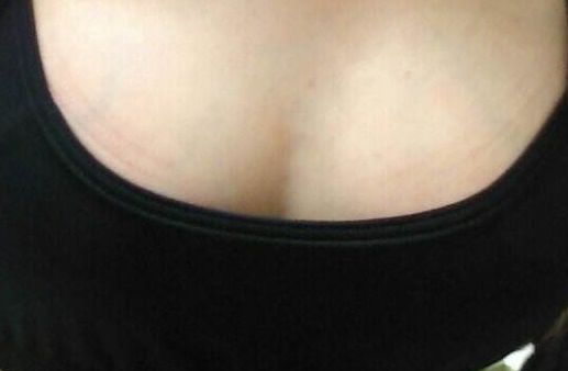 青島哪家醫(yī)院雙眼皮手術效果好，術后無后顧之憂