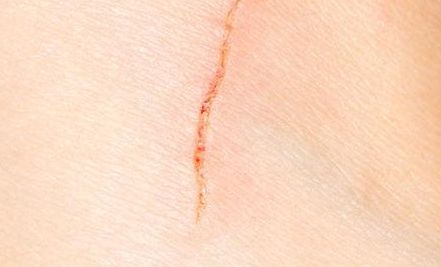 浙江開眼角哪家醫(yī)院技術(shù)好？選擇哪家醫(yī)院效果最佳