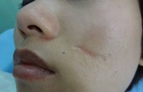 吉林市切開雙眼皮哪家好？一篇詳細(xì)的雙眼皮手術(shù)評(píng)測(cè)指南。