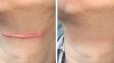 上海哪家醫(yī)院的玻尿酸鼻子效果最好？