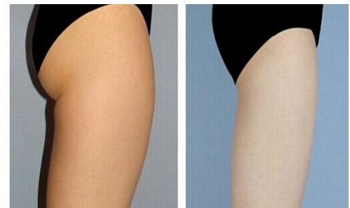 烏魯木齊超聲刀哪家好？烏魯木齊超聲刀醫(yī)院排名及專家推薦