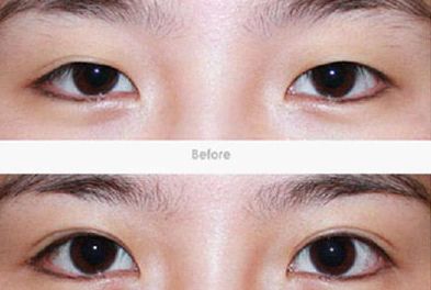 上海雙眼皮手術哪家醫(yī)院好？選擇哪家醫(yī)院最關鍵