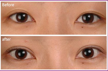 深圳墊鼻梁哪家醫(yī)院技術(shù)好且口碑可信？