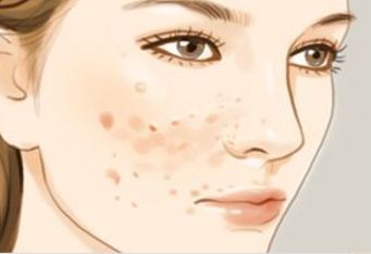 杭州雙眼皮哪家技術(shù)好？了解杭州雙眼皮開眼角好的醫(yī)院