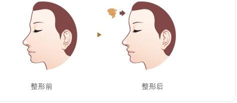 上海翡立思醫(yī)療陳立彬：無痛吸脂撇開隱患，告別粗腿不再是夢