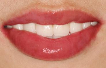 2023義烏點(diǎn)陣激光祛額頭紋排行前10強(qiáng)的專家(李超、曹長清、張小紅本地人尤為認(rèn)可)