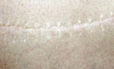 聊城玻尿酸隆鼻哪家好？專業(yè)醫(yī)生推薦幫助您選擇