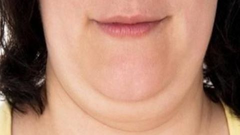 吳佳君醫(yī)生拉皮技術(shù)獨(dú)步一時，值得信賴嗎？費(fèi)用如何計算？