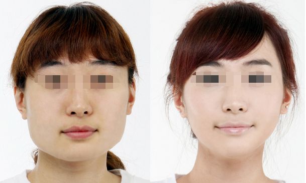 合肥哪家醫(yī)院豐胸效果好，專業(yè)的豐胸醫(yī)院推薦