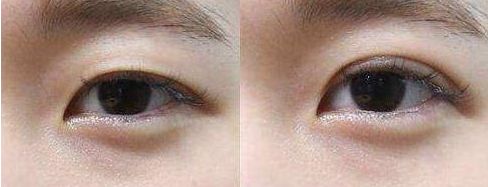 寧波市眼袋手術(shù)哪家醫(yī)院好？