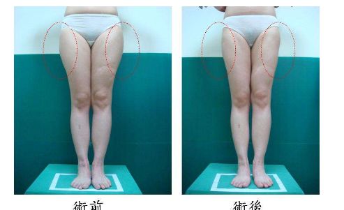 杭州做埋線哪家醫(yī)院好？選擇正規(guī)專業(yè)的醫(yī)療機(jī)構(gòu)，安全可靠！