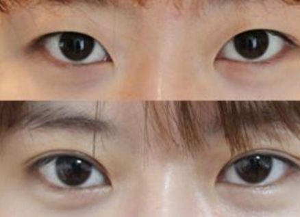 杭州去咖啡斑好的醫(yī)院有哪些？