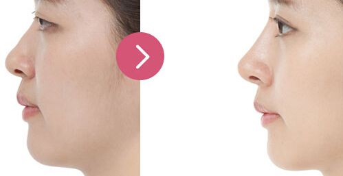 廣州哪家醫(yī)院眼部整形效果好，專業(yè)醫(yī)院推薦